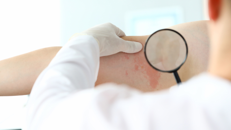 Вебинар «Академия Акне и Розацеа»